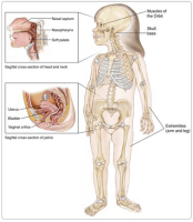 Rhabdomyosarcoma (RMS)