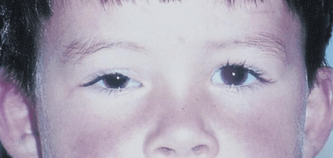 Rhabdomyosarcoma (RMS)